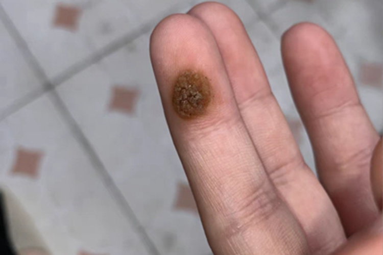 寻常疣手指尖疙瘩图 寻常疣手指尖疙瘩图