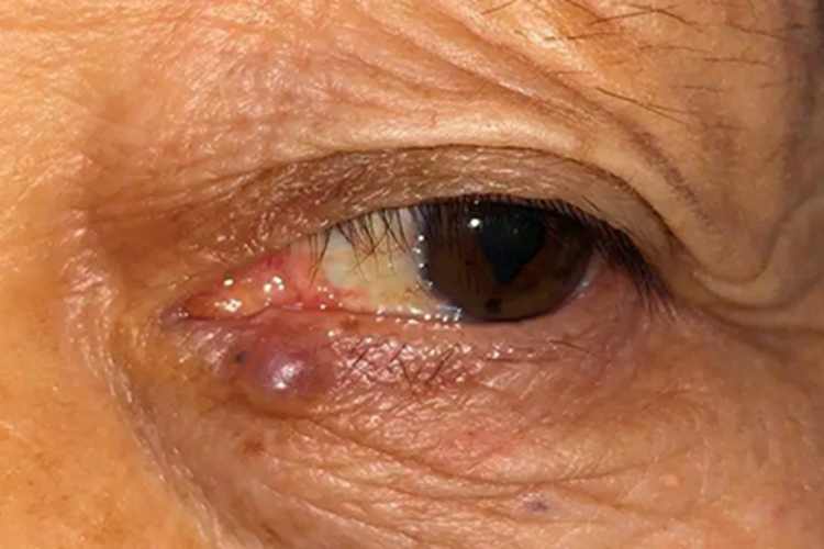 眼睑皮脂腺癌眼睑硬疙瘩图