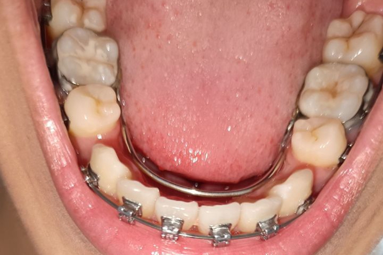 拔牙后牙齿矫正图