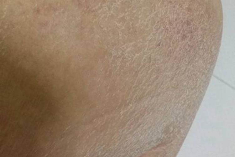 皲裂性湿疹脱屑图