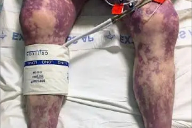 紫癜型药疹腿症状图