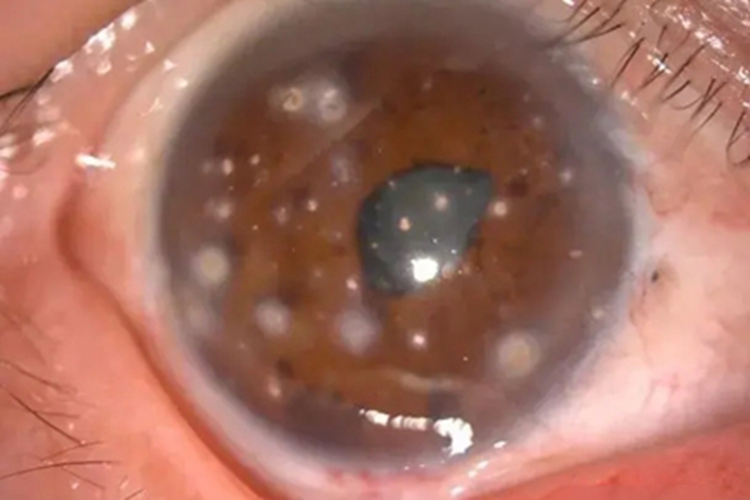 电击伤所致白内障眼部混浊图