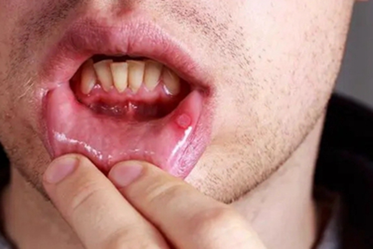 瘢痕性类天疱疮下嘴唇内侧溃疡图 瘢痕性类天疱疮下嘴唇内侧溃疡图