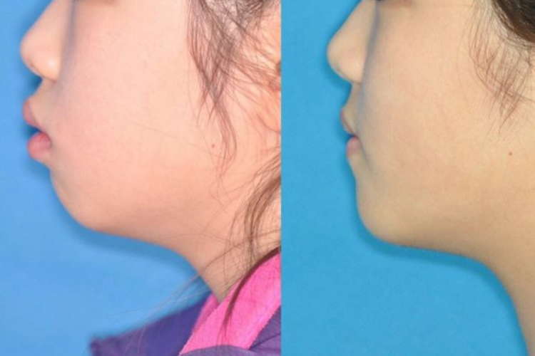 双颌前突矫正对比图