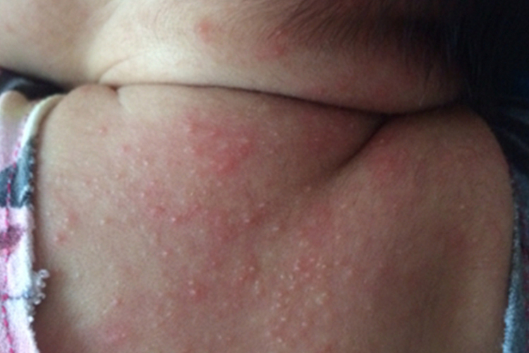 急性湿疹图
