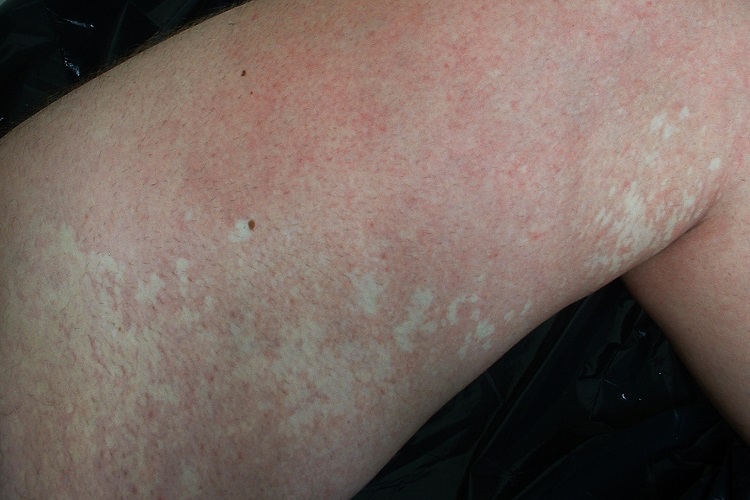 白癜风大腿白斑图