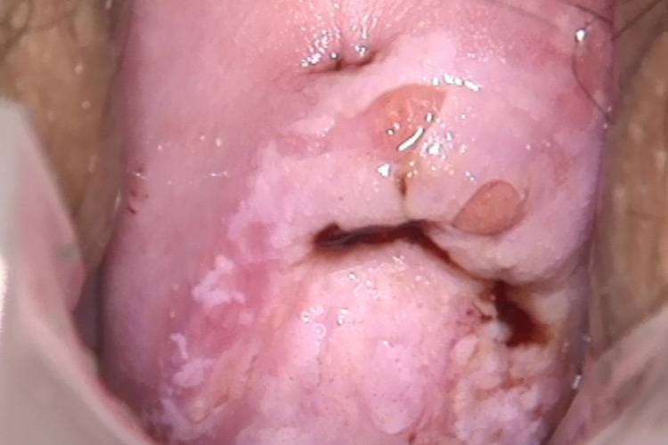 宫颈癌褐色分泌物图