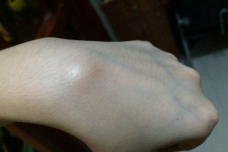 脂肪肉瘤手背疙瘩图