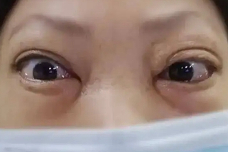 非炎性单纯性突眼眼球突出图 非炎性单纯性突眼眼球突出图