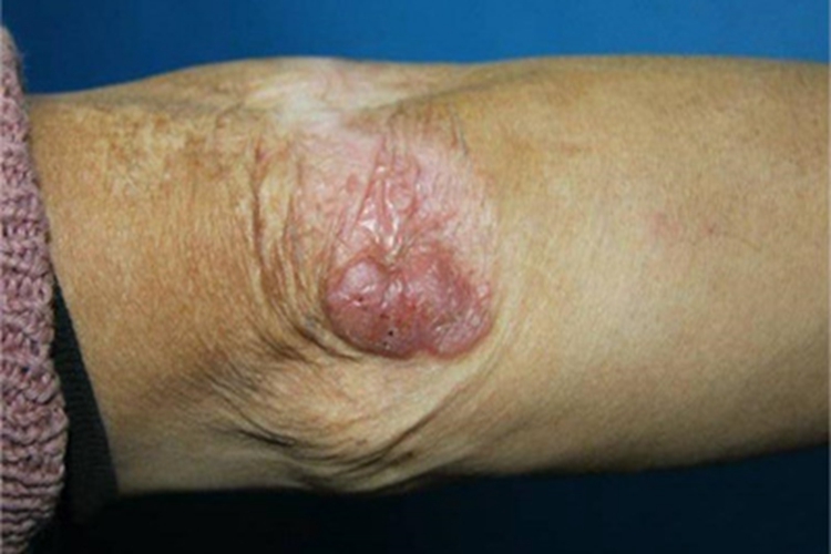 着色芽生菌病肘部症状图