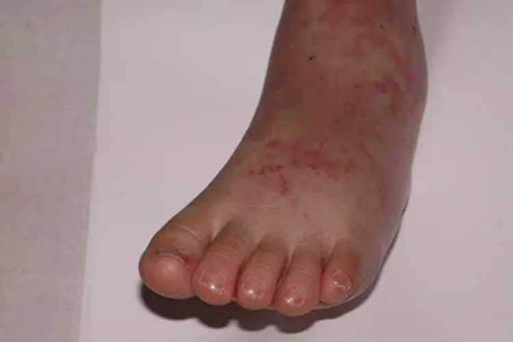 川崎病脚背红斑图