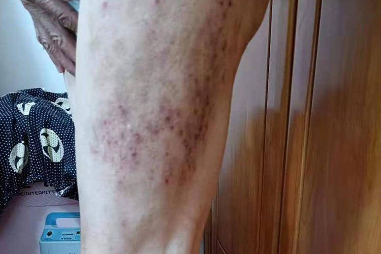 老人亚急性湿疹图