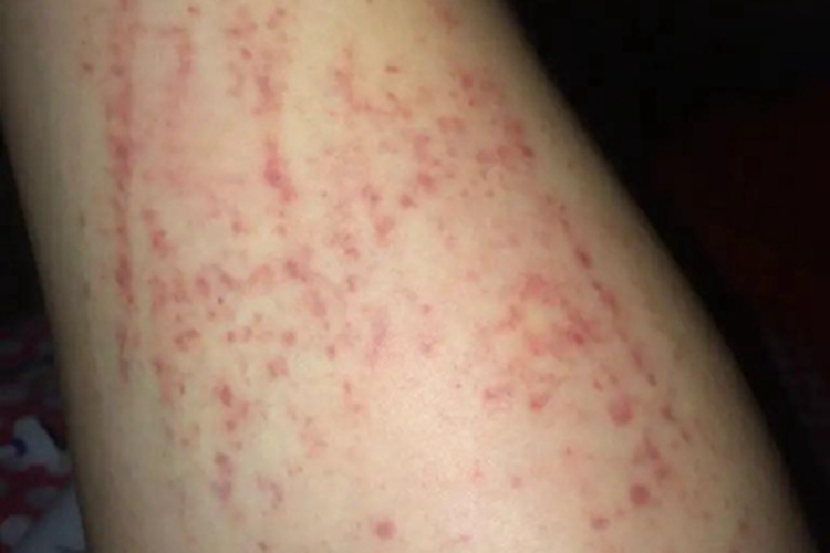 虫咬皮炎抓痕图 虫咬皮炎抓痕图