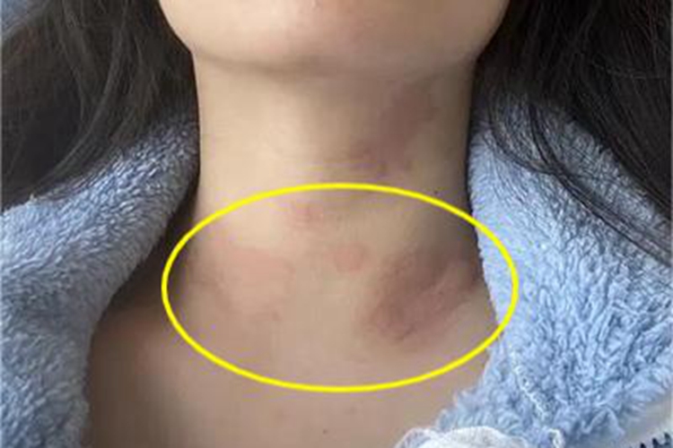 荨麻疹颈部红斑图