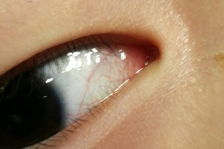 宝宝眼白发红图