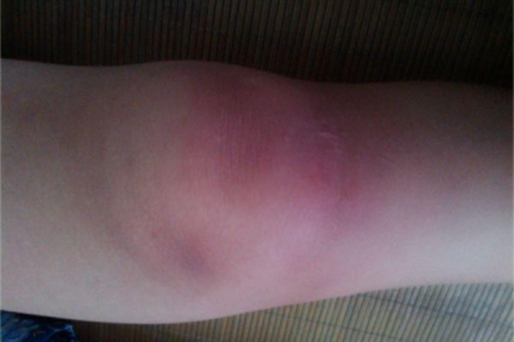 轻度扭伤膝盖红肿图