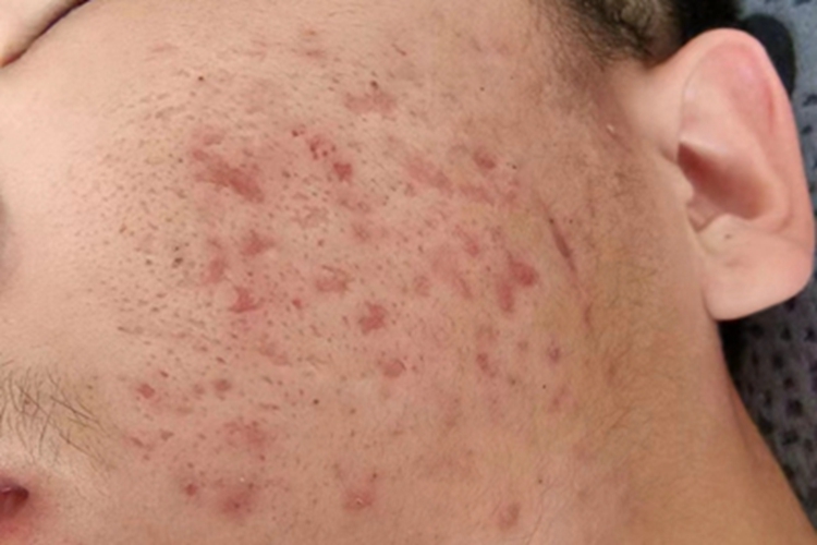 寻常痤疮面部瘢痕图