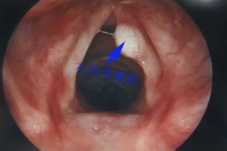 右声带囊肿图