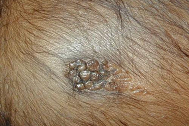 皮脂腺痣头皮疙瘩图