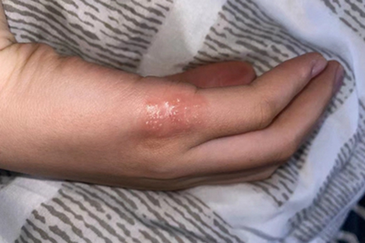 单纯疱疹手侧面好多小水疱图