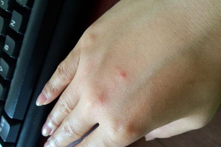 蚊虫叮咬手背上小红点图 蚊虫叮咬手背上小红点图