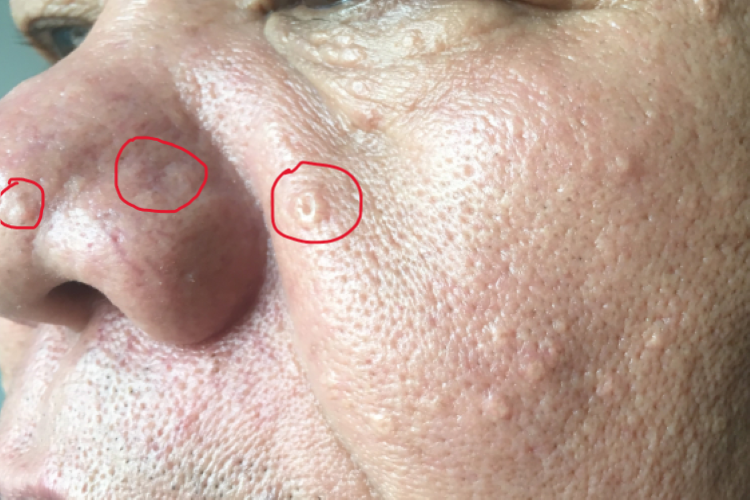 老年性皮脂腺增生图