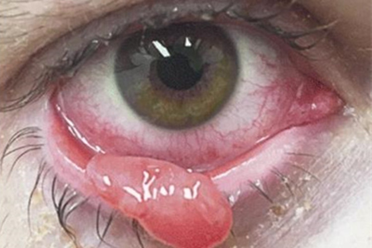 结膜乳头状瘤眼睑肉球图