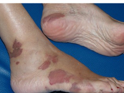 卡波西肉瘤的症状和图片 - 有来医生