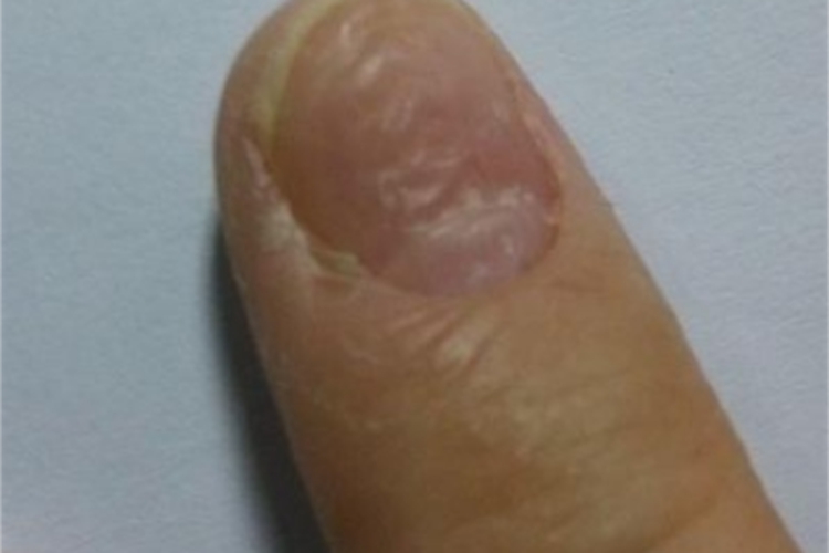 甲凹点指甲不平整图