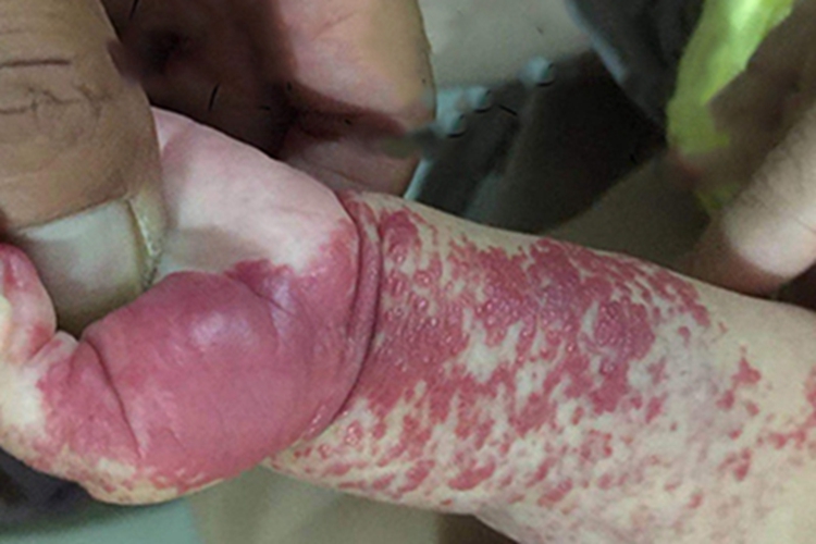 血管瘤疙瘩图 血管瘤疙瘩图