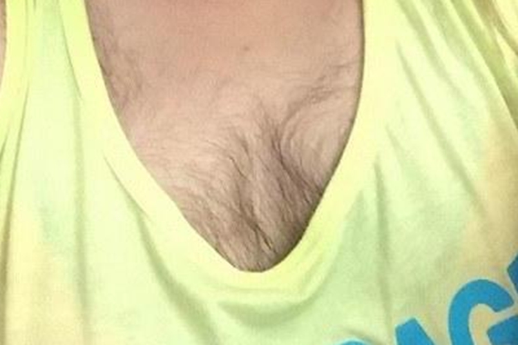 女性多毛症胸部长胸毛图