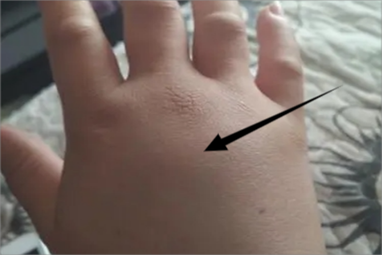 特发性水肿手部水肿图