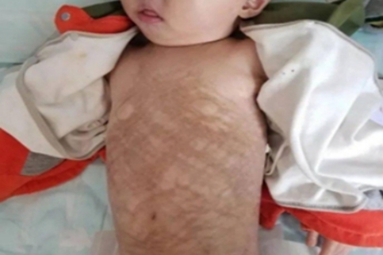 嗜酸性筋膜炎腹部症状图 嗜酸性筋膜炎腹部症状图