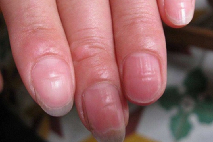 脆甲症手指甲有竖纹凹陷图 脆甲症手指甲有竖纹凹陷图