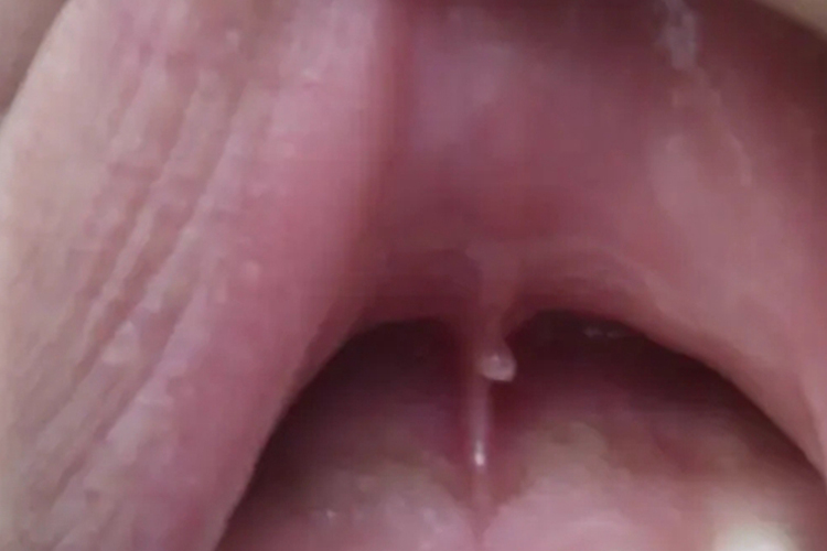 扁平苔藓上唇系带丘疹样变图