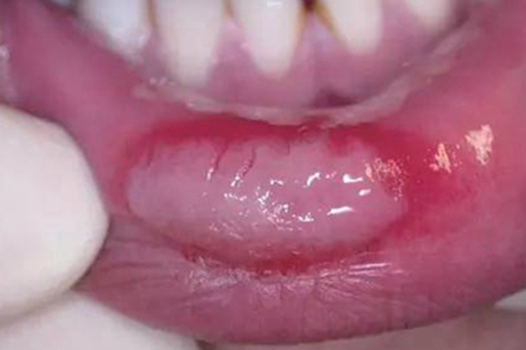 二期口腔梅毒症状图