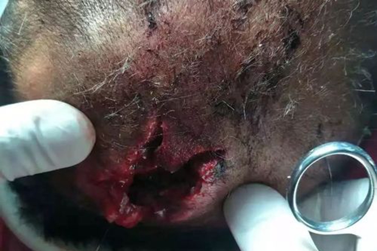 头皮裂伤图