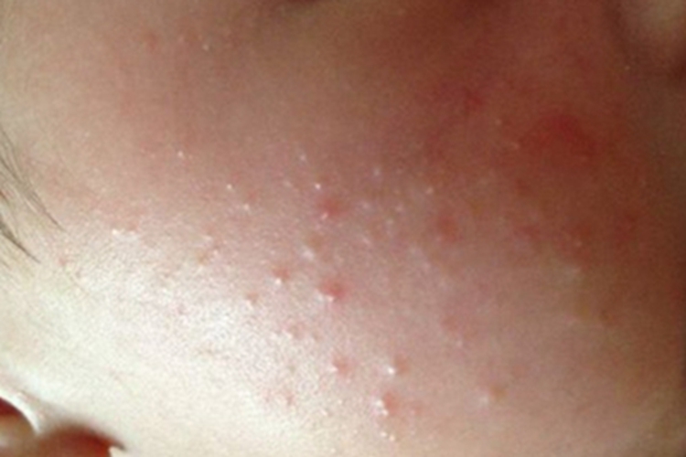 奶癣脸颊有很多小疙瘩图 奶癣脸颊有很多小疙瘩图