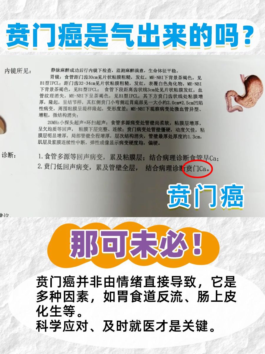 贲门癌是气出来的吗？那可未必！