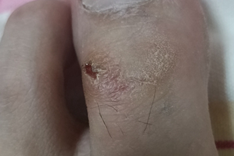 亚急性湿疹脚部症状图