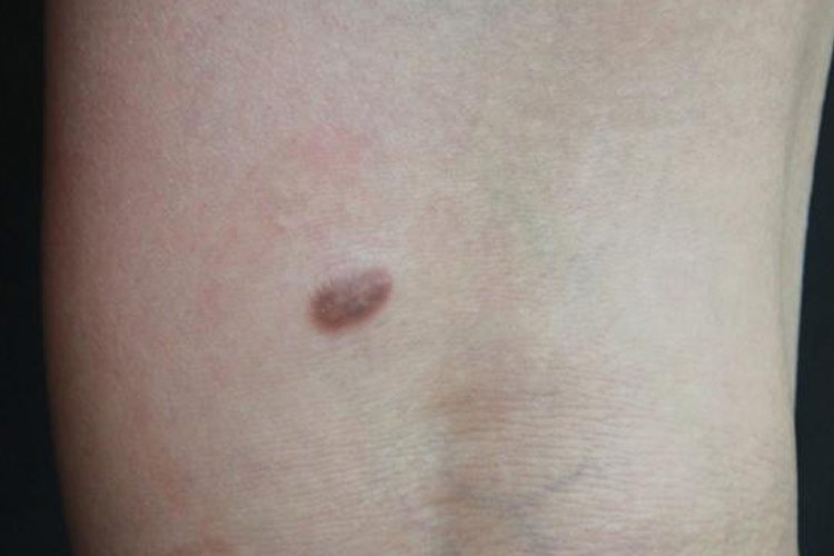 黄褐色皮肤纤维瘤图