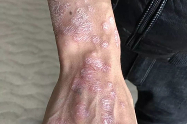 苔藓状淀粉样变手背红斑图