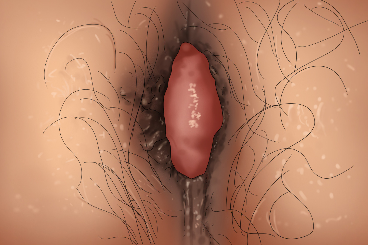 女性血栓性外痔图