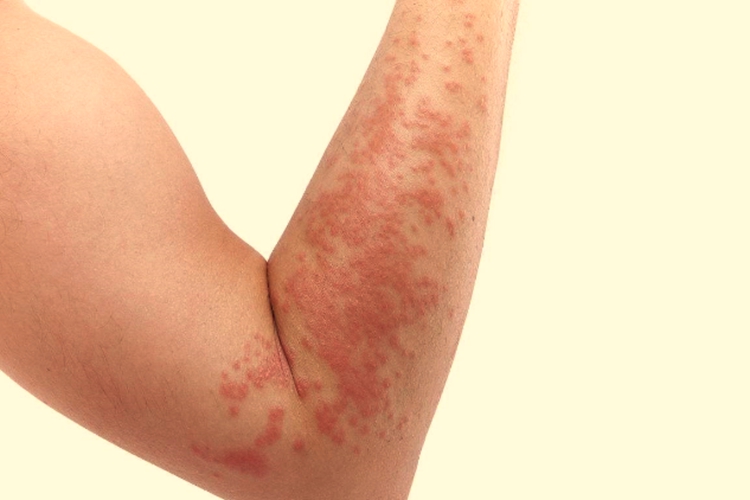 轻微甲醛过敏皮肤图