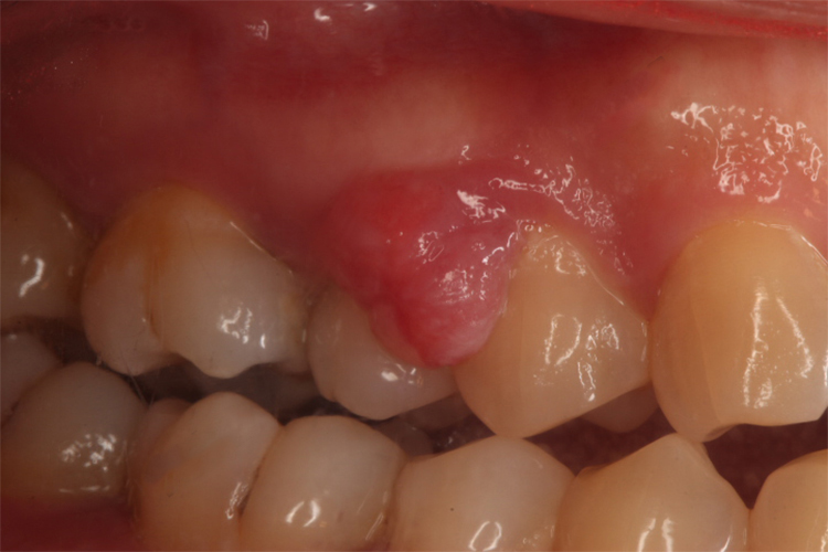 上牙龈牙龈瘤图 上牙龈牙龈瘤图