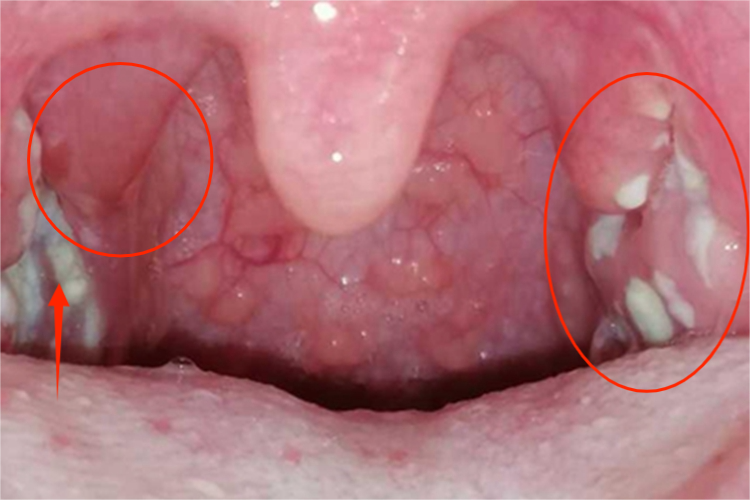 急性隐窝性扁桃体炎扁桃体肿图