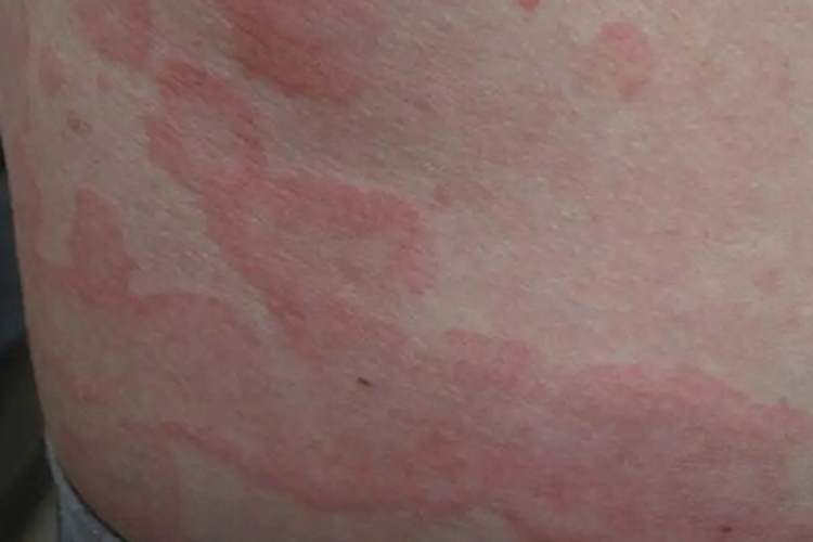 匐行性回状红斑腰部症状图