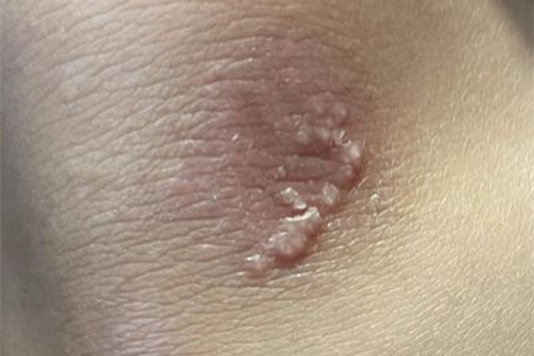 继发性粟丘疹膝盖丘疹图