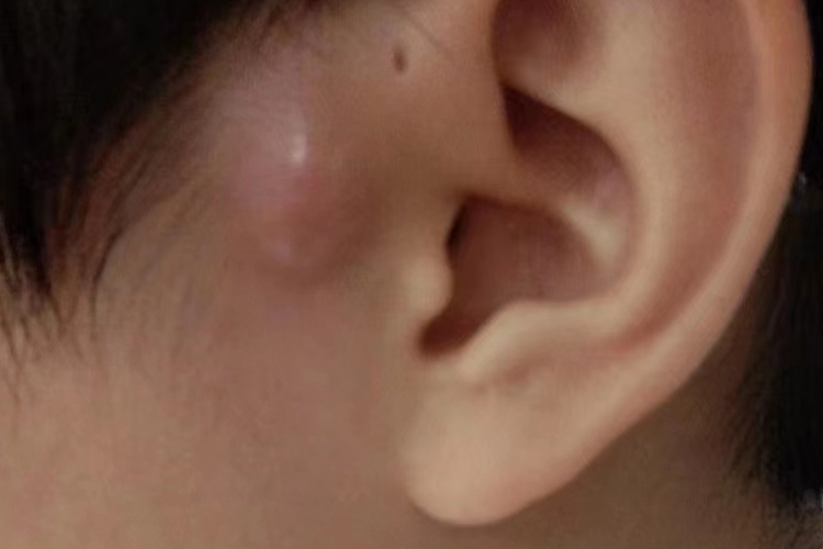 耳前瘘管感染图