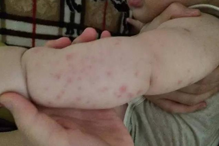 婴儿虫咬皮炎风团图